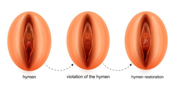 cirugia genital intima labioplastia rejuvenecimiento genital vaginal