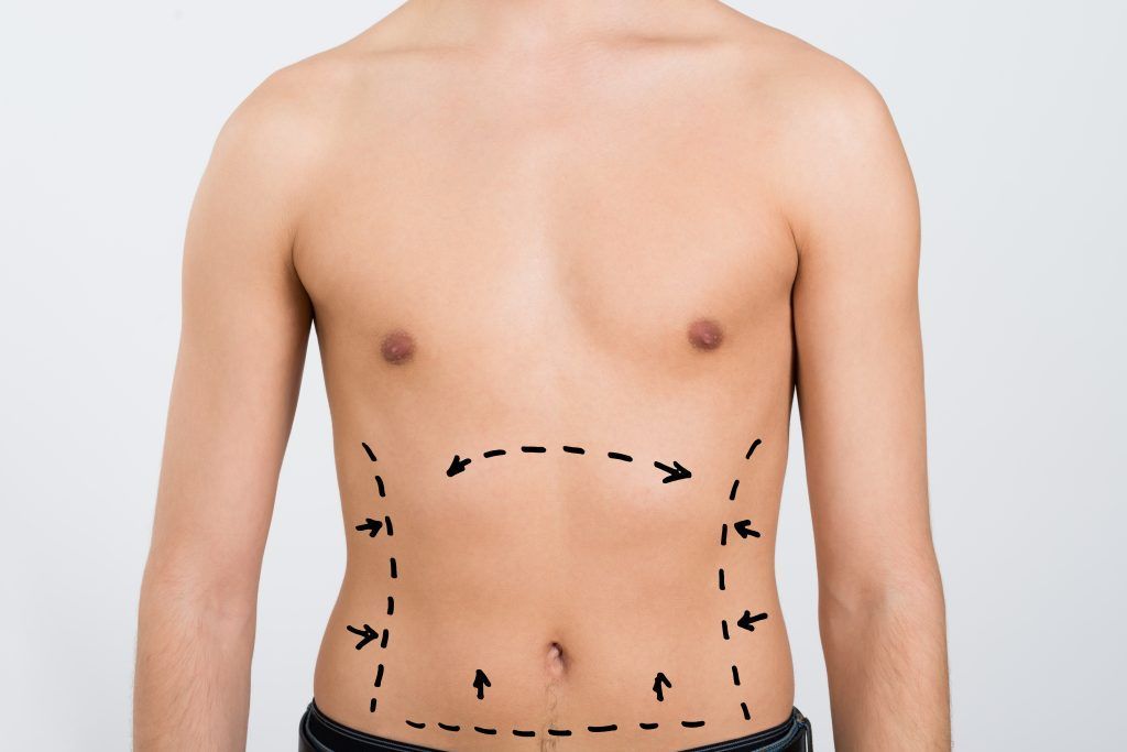 liposucción lipoescultura hombre cirugia plastica estetica sevilla