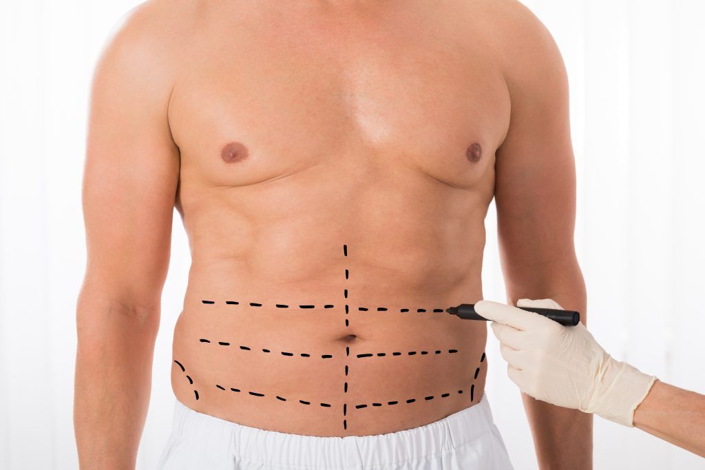 liposucción lipoescultura hombre cirugia plastica estetica sevilla