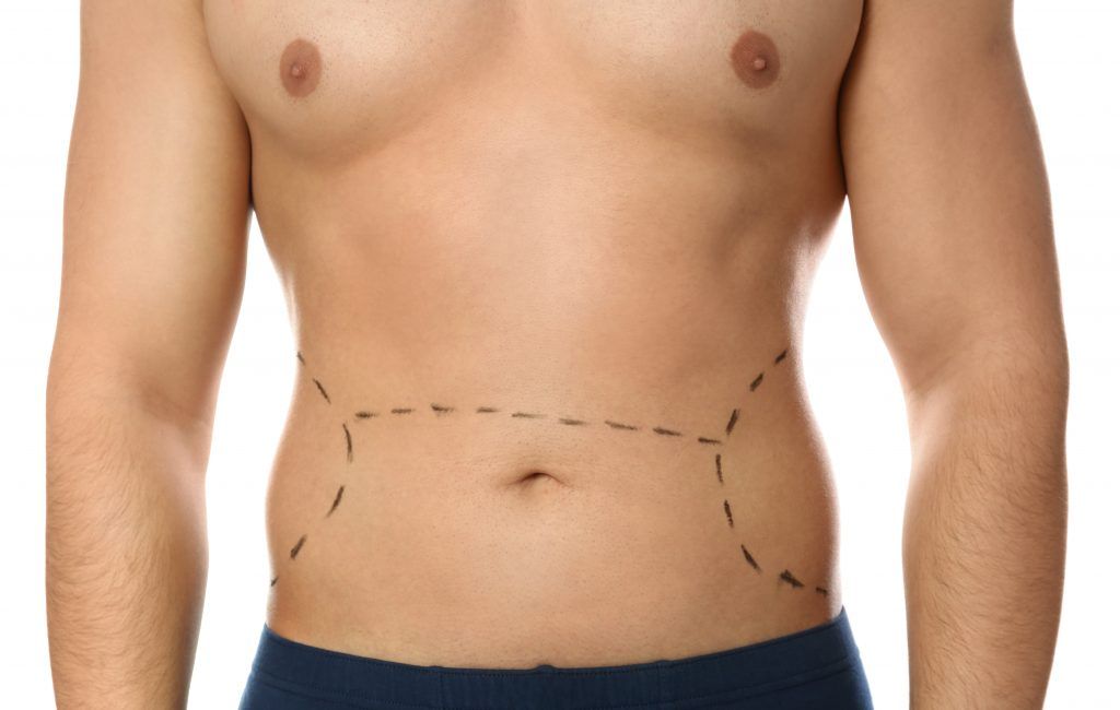 liposucción lipoescultura hombre cirugia plastica estetica sevilla
