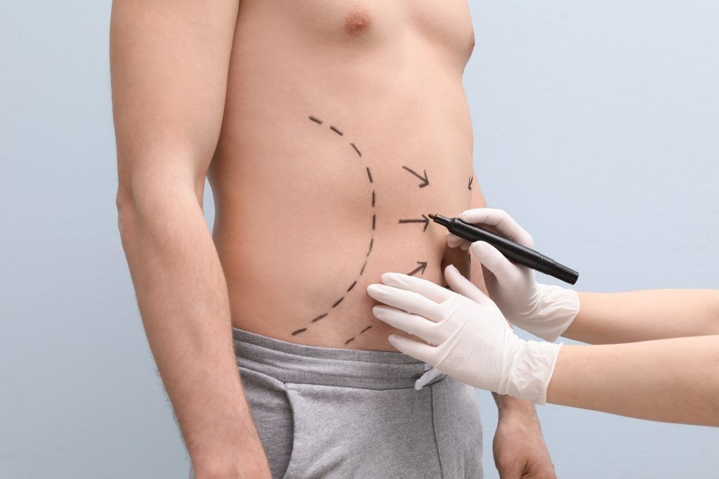 liposucción lipoescultura hombre cirugia plastica estetica sevilla