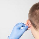 otoplastia infantil