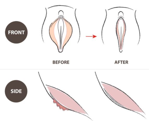 cirugia genital intima labioplastia rejuvenecimiento genital vaginal