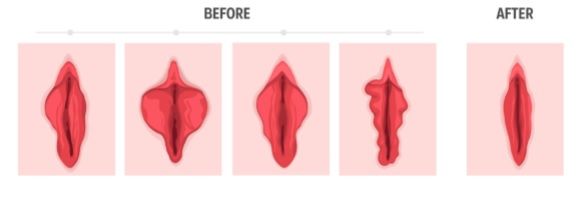 cirugia genital intima labioplastia rejuvenecimiento genital vaginal 