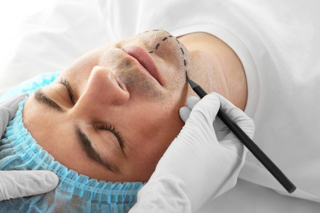 relleno facial hialuronico arrugas menton hombre