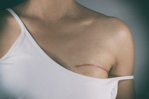 tipos de reconstrucción de mama