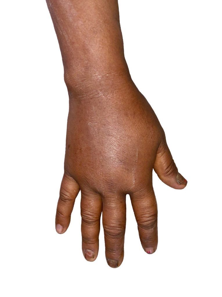 mano linfedema