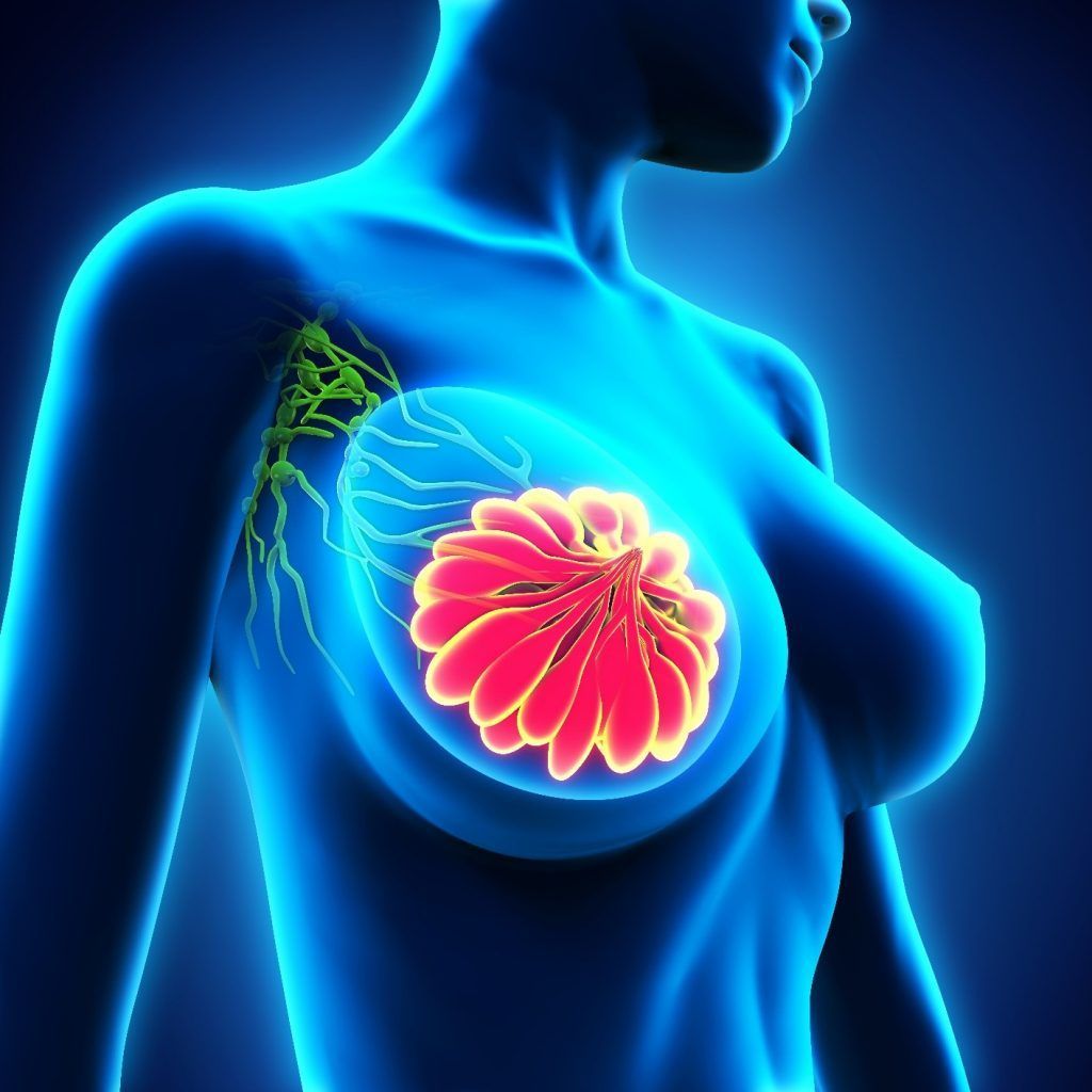 linfedema cancer mama