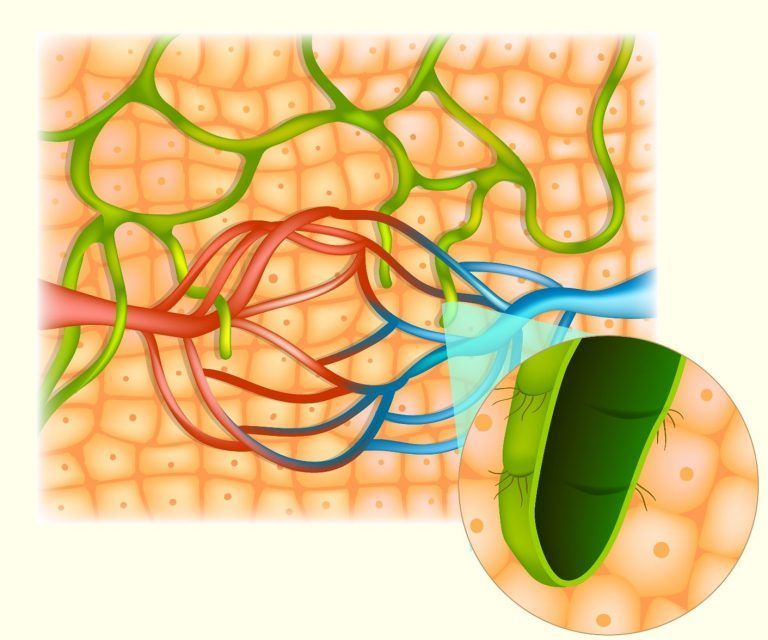 tejido linfedema