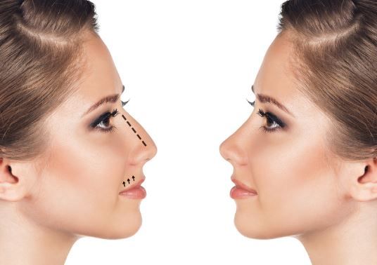 beneficios de la rinoplastia