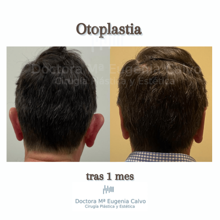 220216 otoplastia