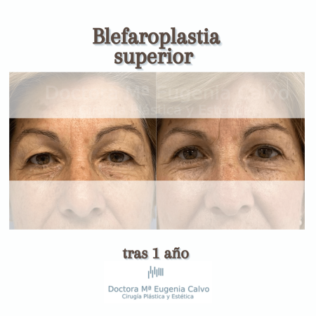 220705 Blefaroplastia