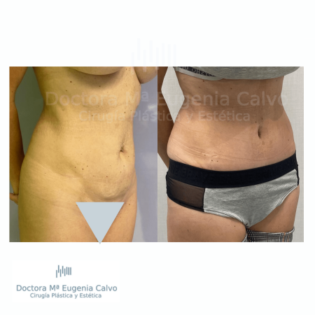 abdominoplastia sevilla caso real