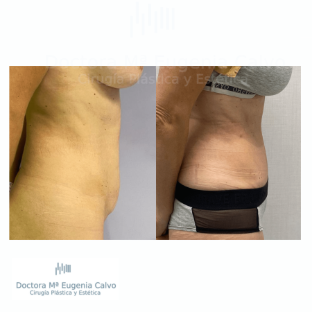 abdominoplastia sevilla caso real