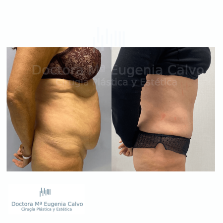 abdominoplastia y liposucción sevilla caso real