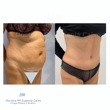 abdominoplastia y liposucción sevilla caso real