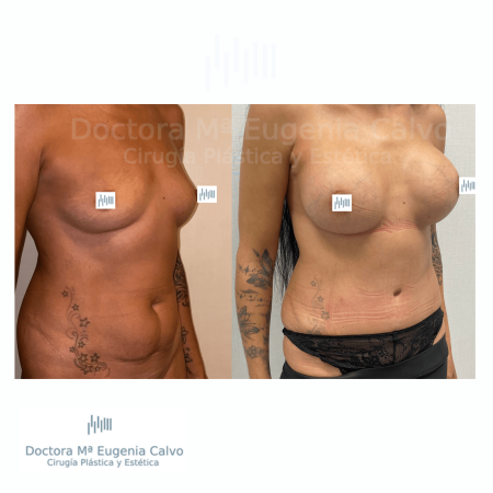 abdominoplastia y aumento mamario sevilla caso real
