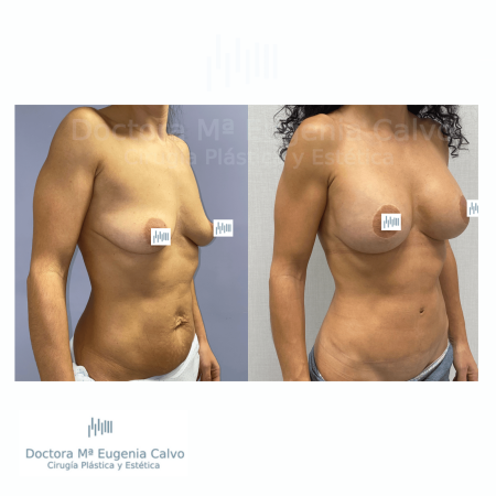 abdominoplastia y aumento mamario sevilla caso real