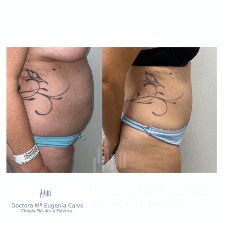 abdominoplastia y liposucción sevilla caso real