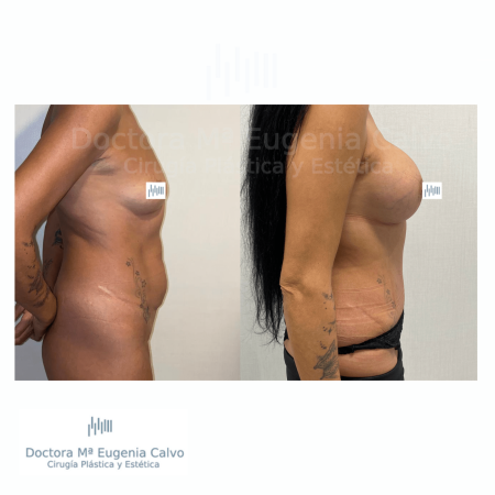 abdominoplastia y aumento mamario sevilla caso real