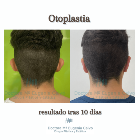 otoplastia cirugia orejas