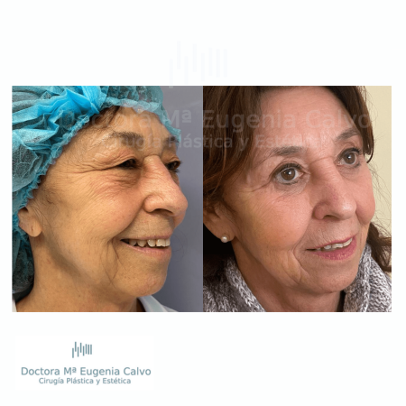 blefaroplastia fotos