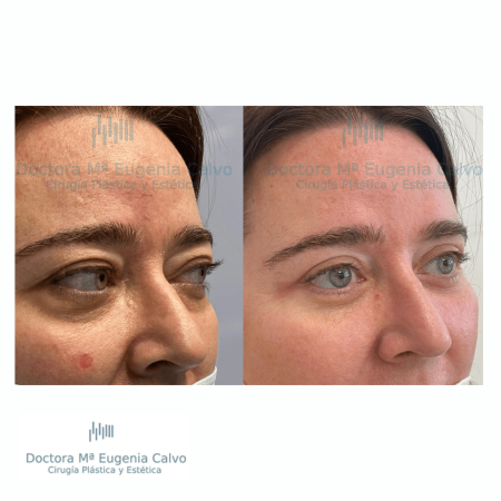 blefaroplastia fotos