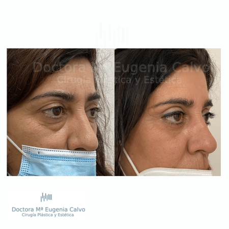 blefaroplastia fotos