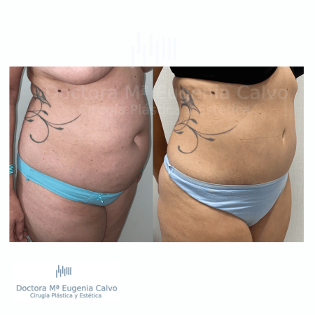 abdominoplastia y liposucción sevilla caso real