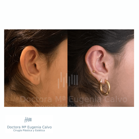 otoplastia