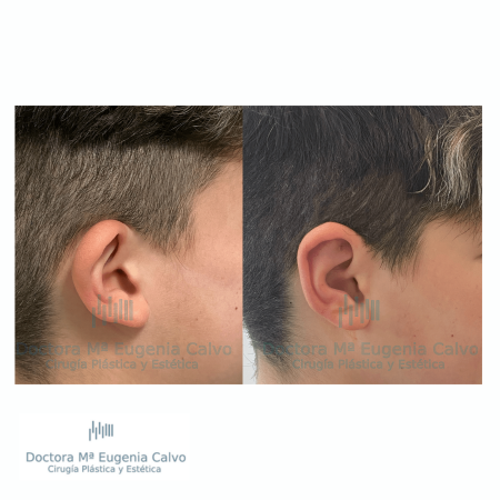 otoplastia cirugia orejas