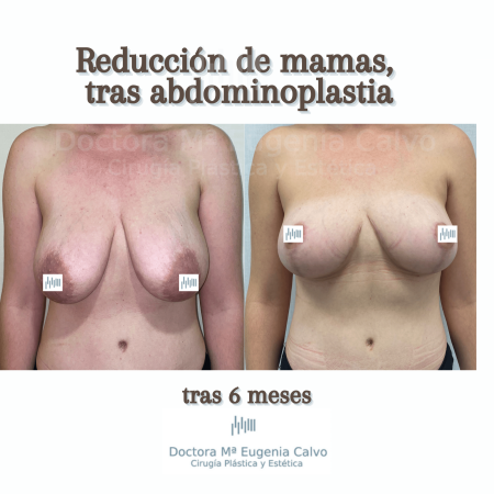 Reducción de mamas