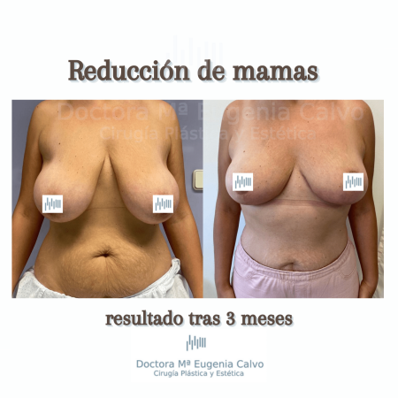 Reducción de mamas