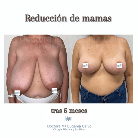 reducción de mamas