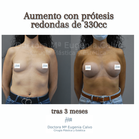 Aumento mamario prótesis redondas