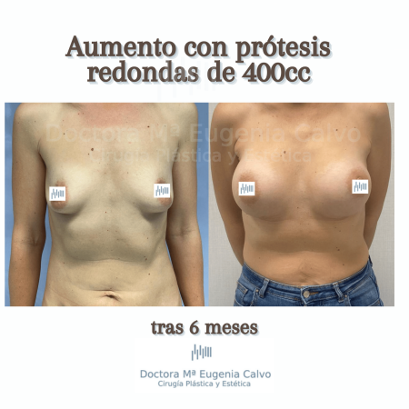 aumento de mamas prótesis redondas