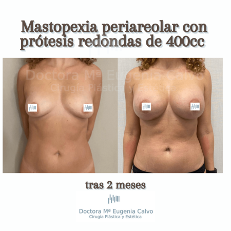 aumento prótesis redondas