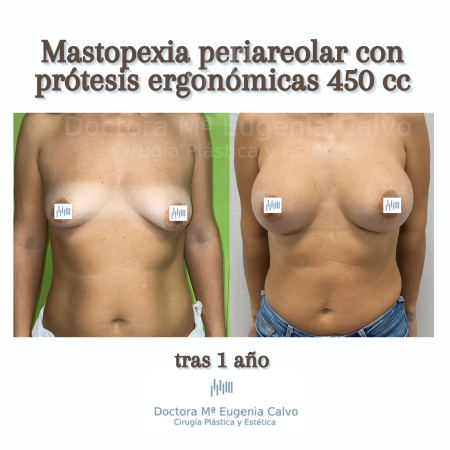aumento con prótesis egonómicas