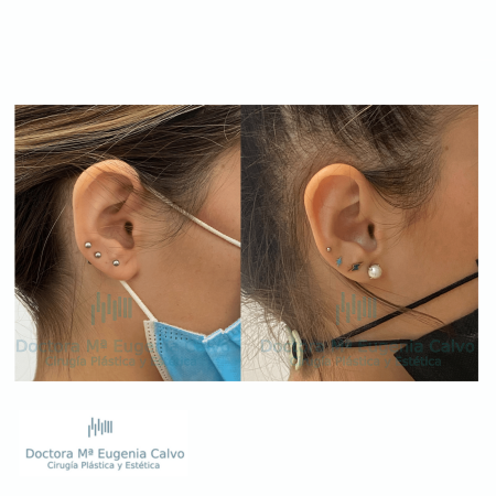 otoplastia cirugía orejas