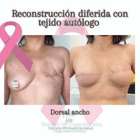 reconstrucción de mama foto