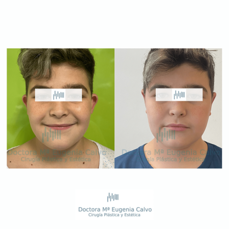 otoplastia cirugia orejas