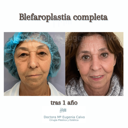 blefaroplastia fotos
