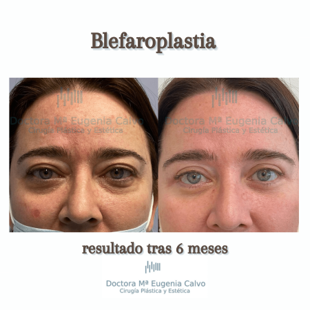 blefaroplastia fotos