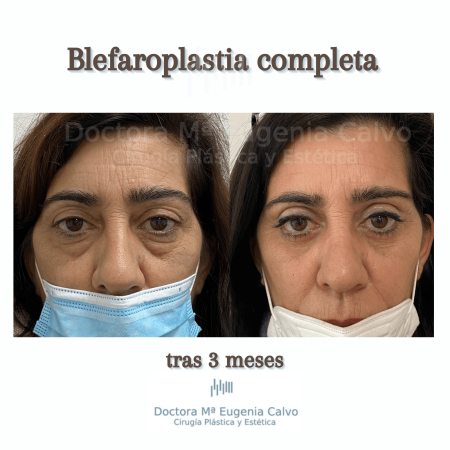 blefaroplastia fotos
