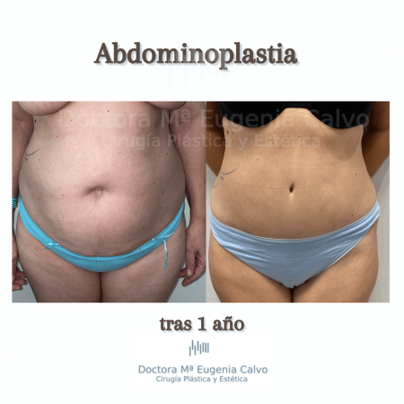 abdominoplastia y liposucción sevilla caso real