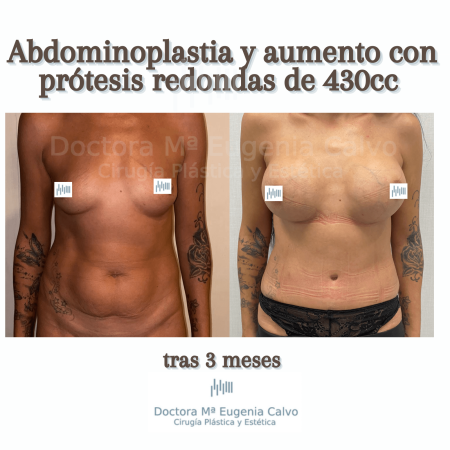 aumento de mamas con prótesis redondas