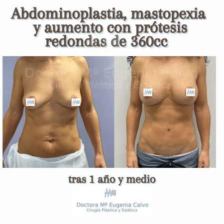 aumento de mamas con prótesis redondas