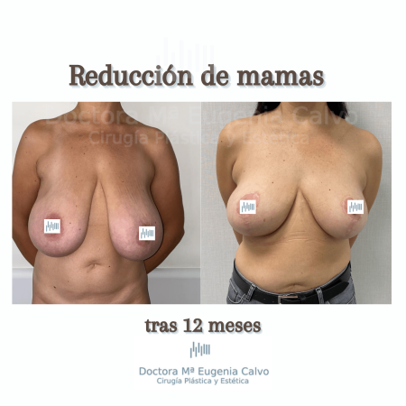 reducción mamas real