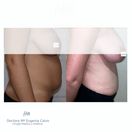 abdominoplastia sevilla