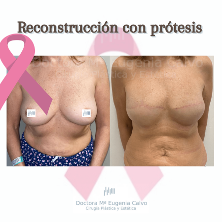 reconstrucción de mama foto